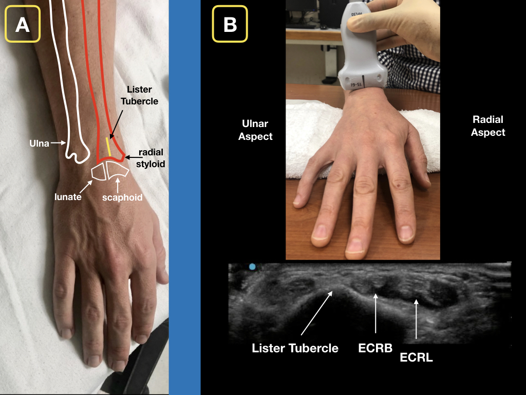 Easy Ultrasound Technique to Evaluate and Aspirate an Atraumatic