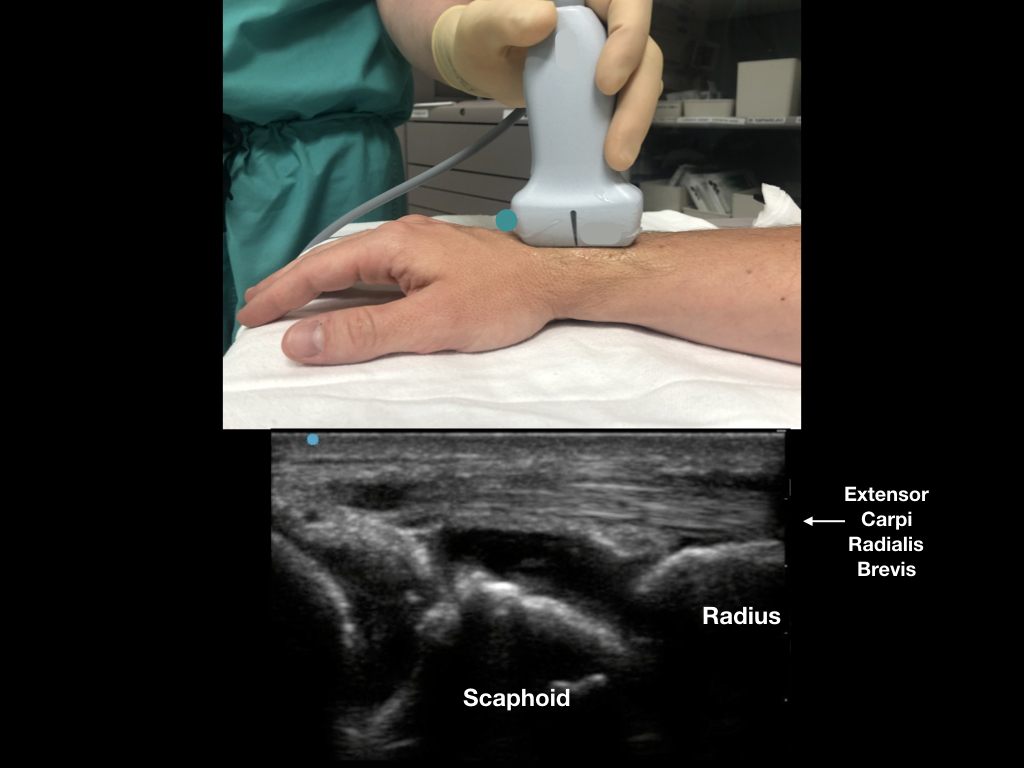 Easy Ultrasound Technique to Evaluate and Aspirate an Atraumatic