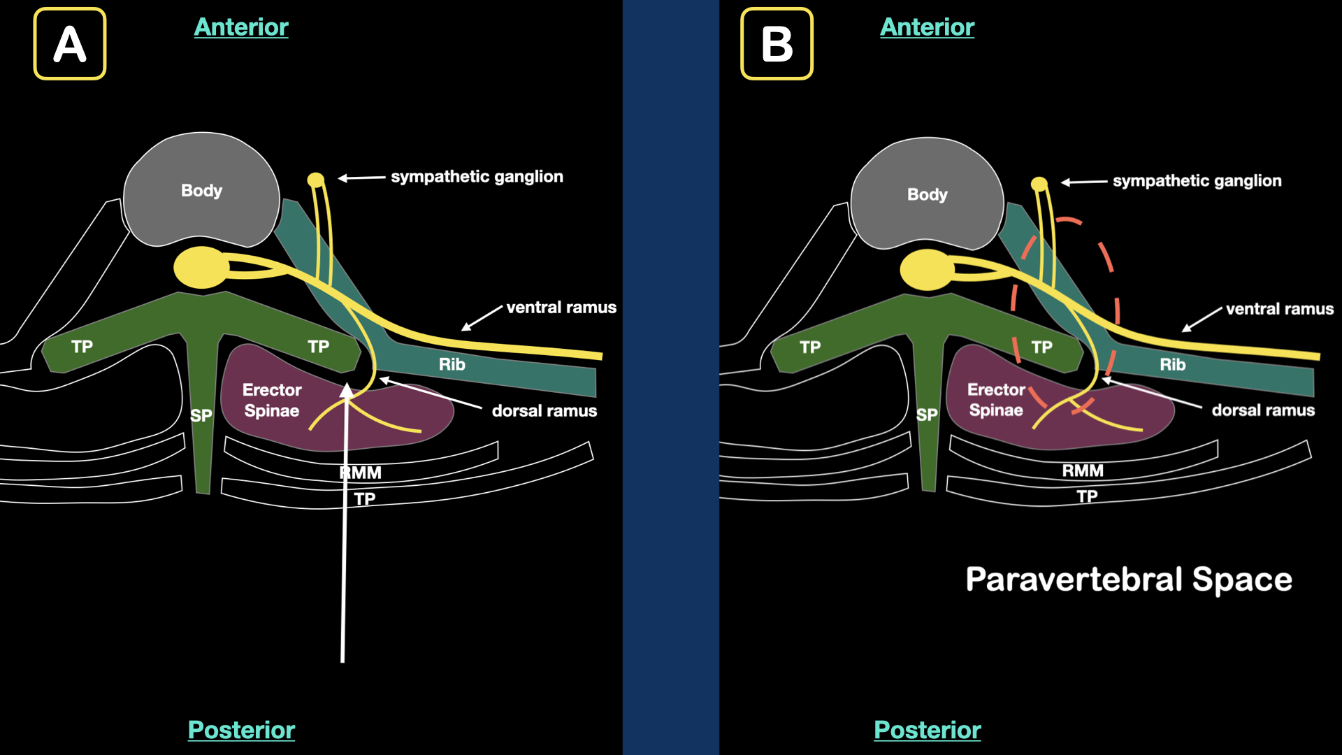How to Perform an Erector Spinae Plane Block ACEP Now