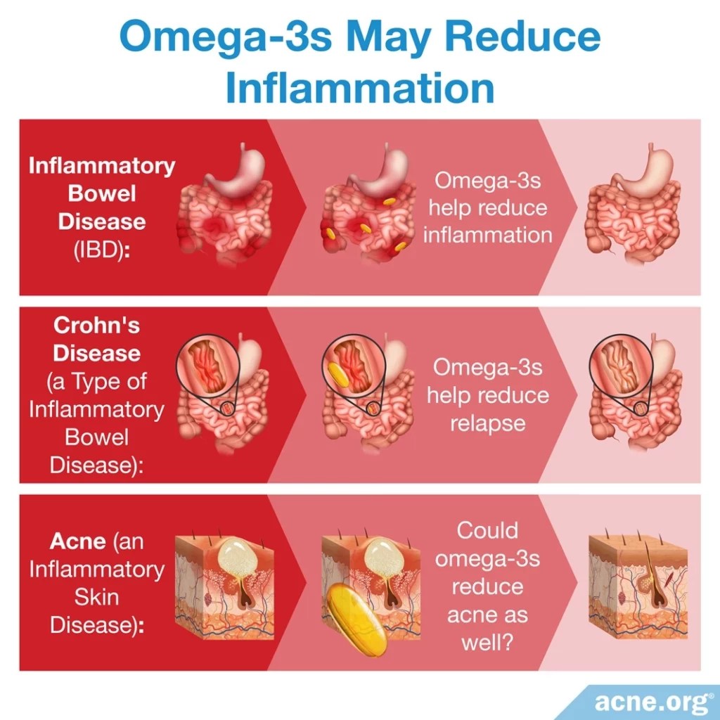 Omega3 Fatty Acids and Acne