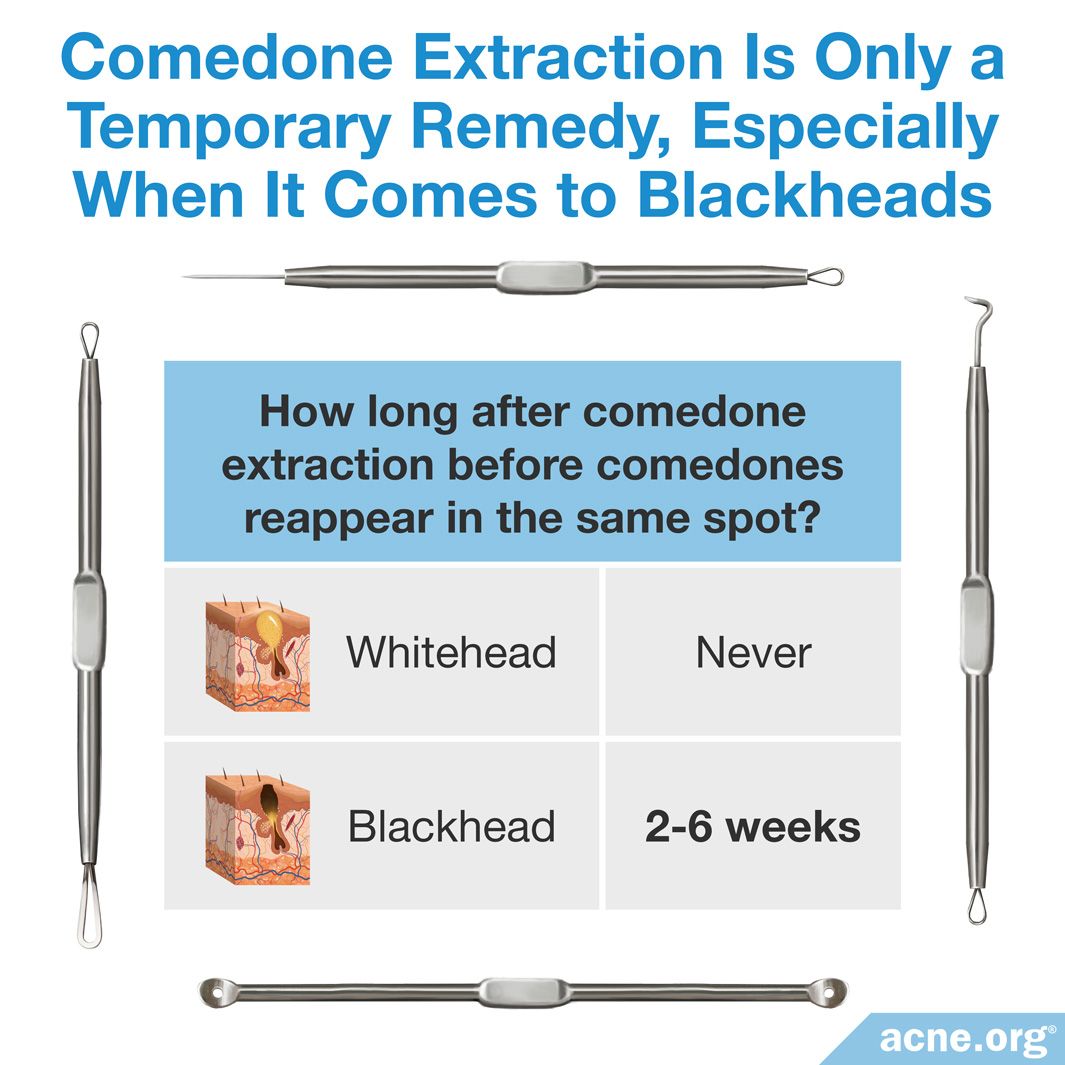 What Is Comedone Extraction, and Should You Do It?