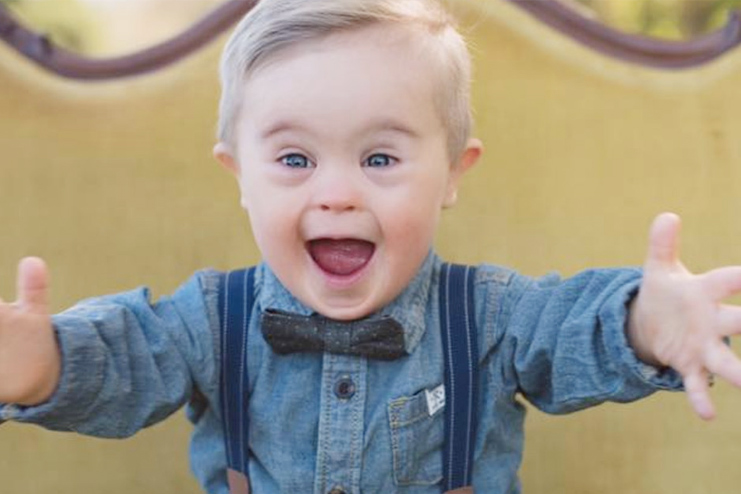 Down Syndrome in Babies Types, Causes, Signs, Symptoms And Treatment