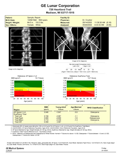 What do the numbers on a DEXA scan actually mean? - Active Seniors