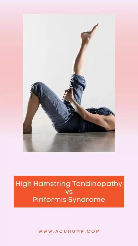 High Hamstring Tendinopathy vs Piriformis Syndrome Blog