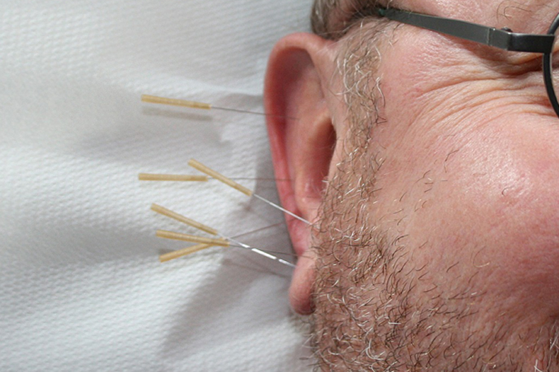 EAR ACUPUNCTURE