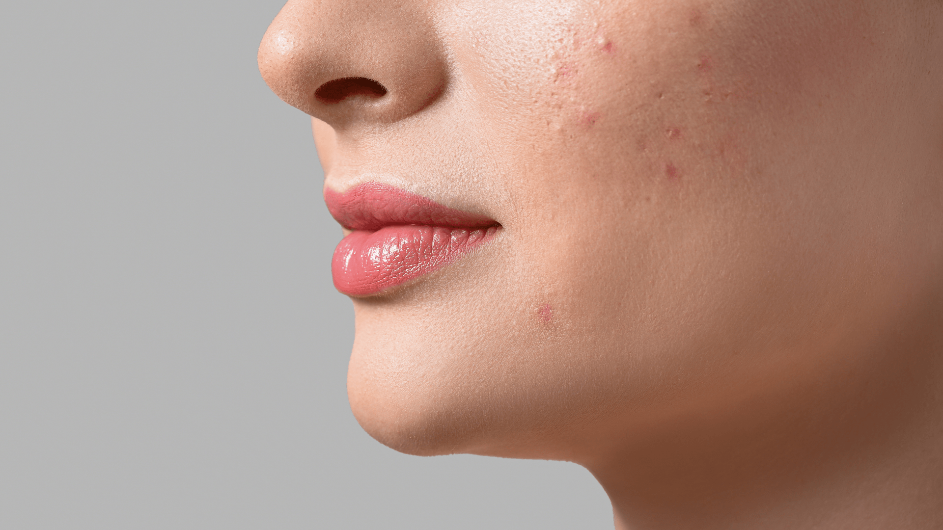 SILVER ACNE X REVOLUTIONARY TREATMENT AGAINST ACNE AND BLEMISHES