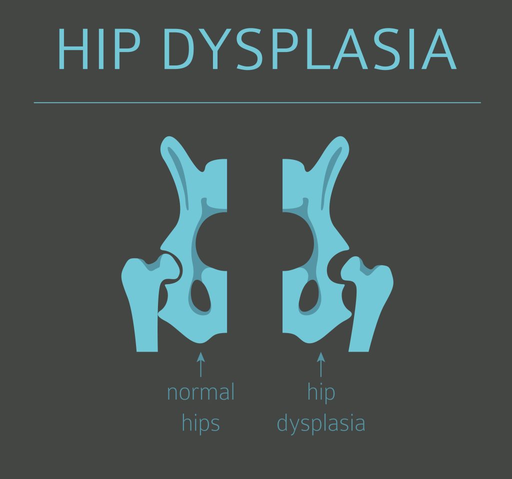 Hip Dysplasia Add More to Life Meril
