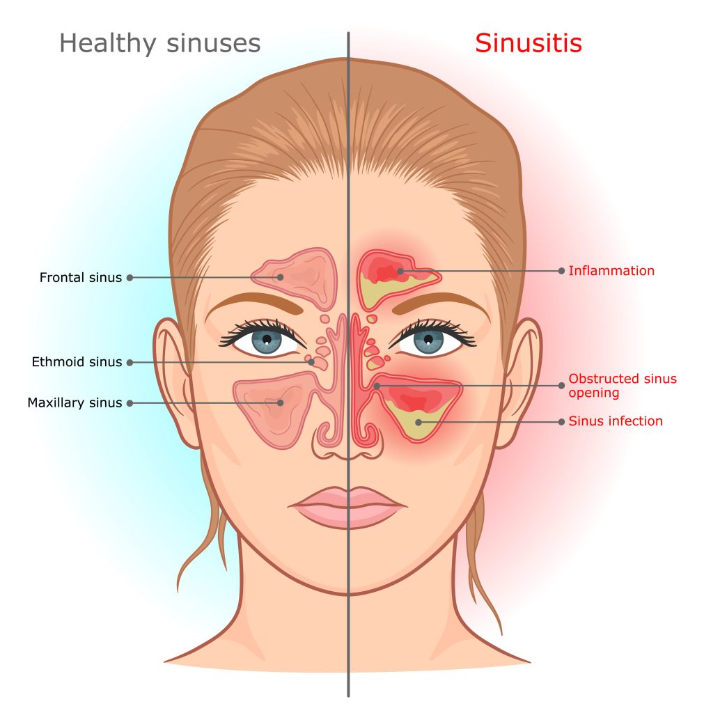 Sinus Infection Warning Signs And Symptoms When to See a Doctor for