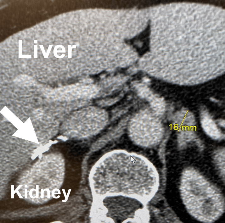 When is Partial Adrenal Surgery Best?