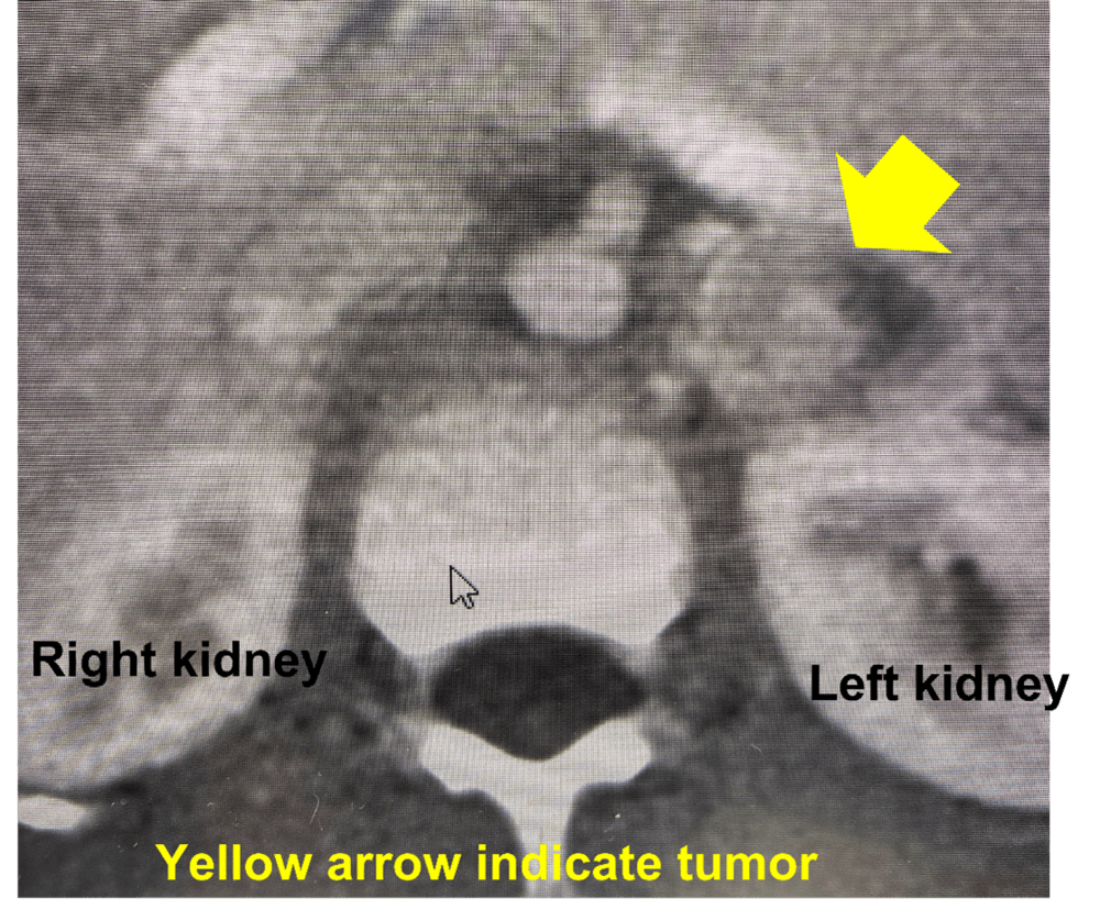 Adrenal tumors in children What you need to know