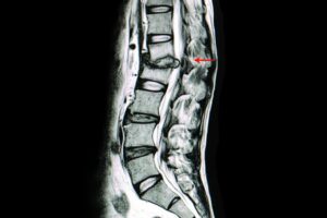 What Does a Herniated Disc Look Like on an MRI? - ADR