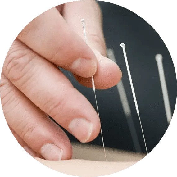 The risks of Dry needling and how to avoid them Physioverse Academy