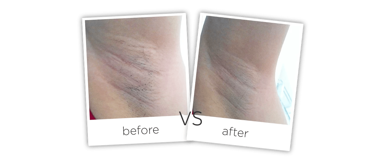 Korea IPL Laser Machine Korea IPL Hair Removal Machine For Sale
