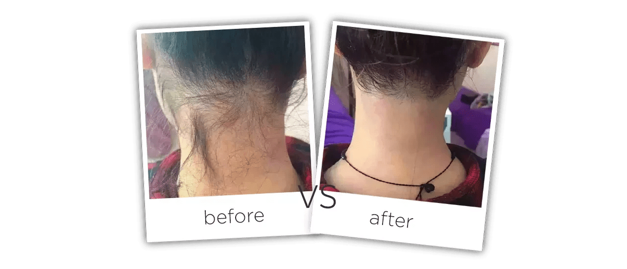 755nm/808nm/1064nm Diode Laser Hair Removal Device ADSS Laser