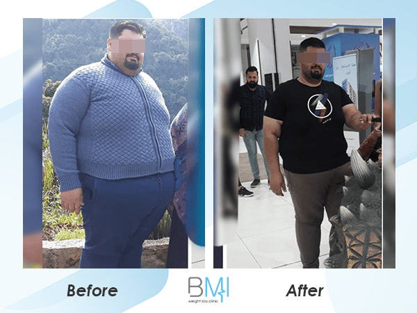 Weight loss surgery before and after Advanced BMI Lebanon Dr Nagi