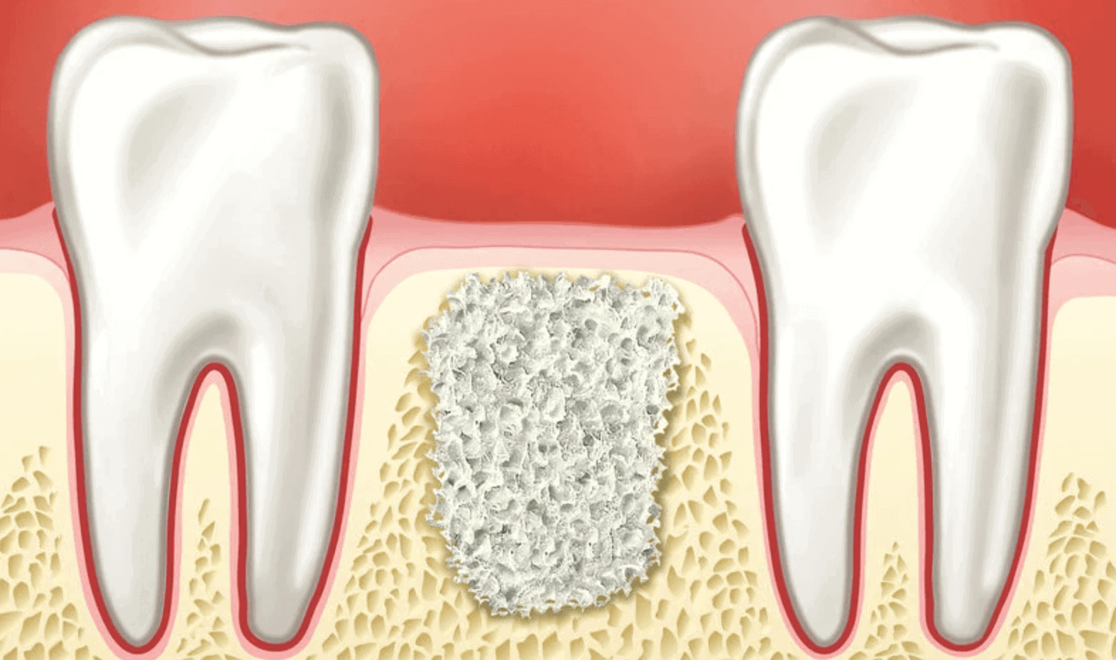 How can alveolar Socket Preservation Help you in Replacement