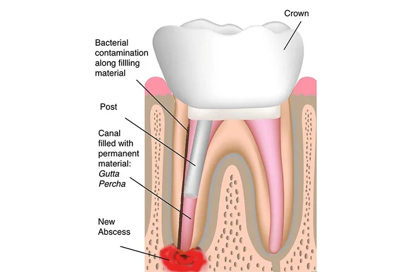 Advanced Endodontics Of New York Endodontist Manhattan