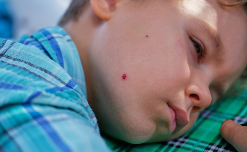 Cherry Hemangioma Baby