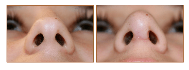 Pictures Rhinoplasty Nose Job Orlando, Pictures Rhinoplasty Nose Job