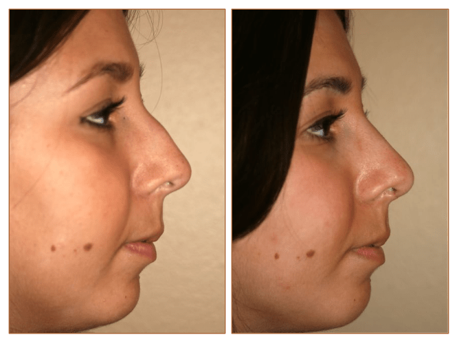 Pictures Rhinoplasty Nose Job Orlando, Pictures Rhinoplasty Nose Job