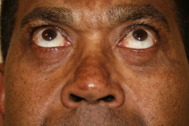 Eye Lid Surgery Or Blepharoplasty Advanced Faces
