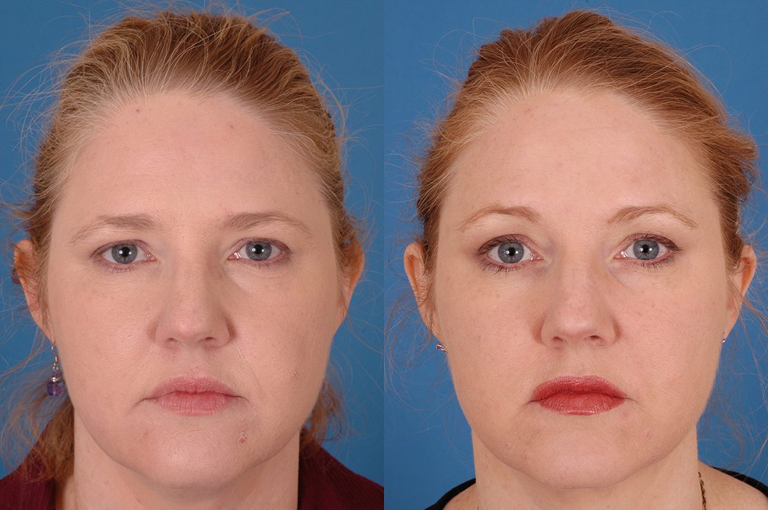 Brow Lift Before & After Photos Dr. Benjamin Bassichis