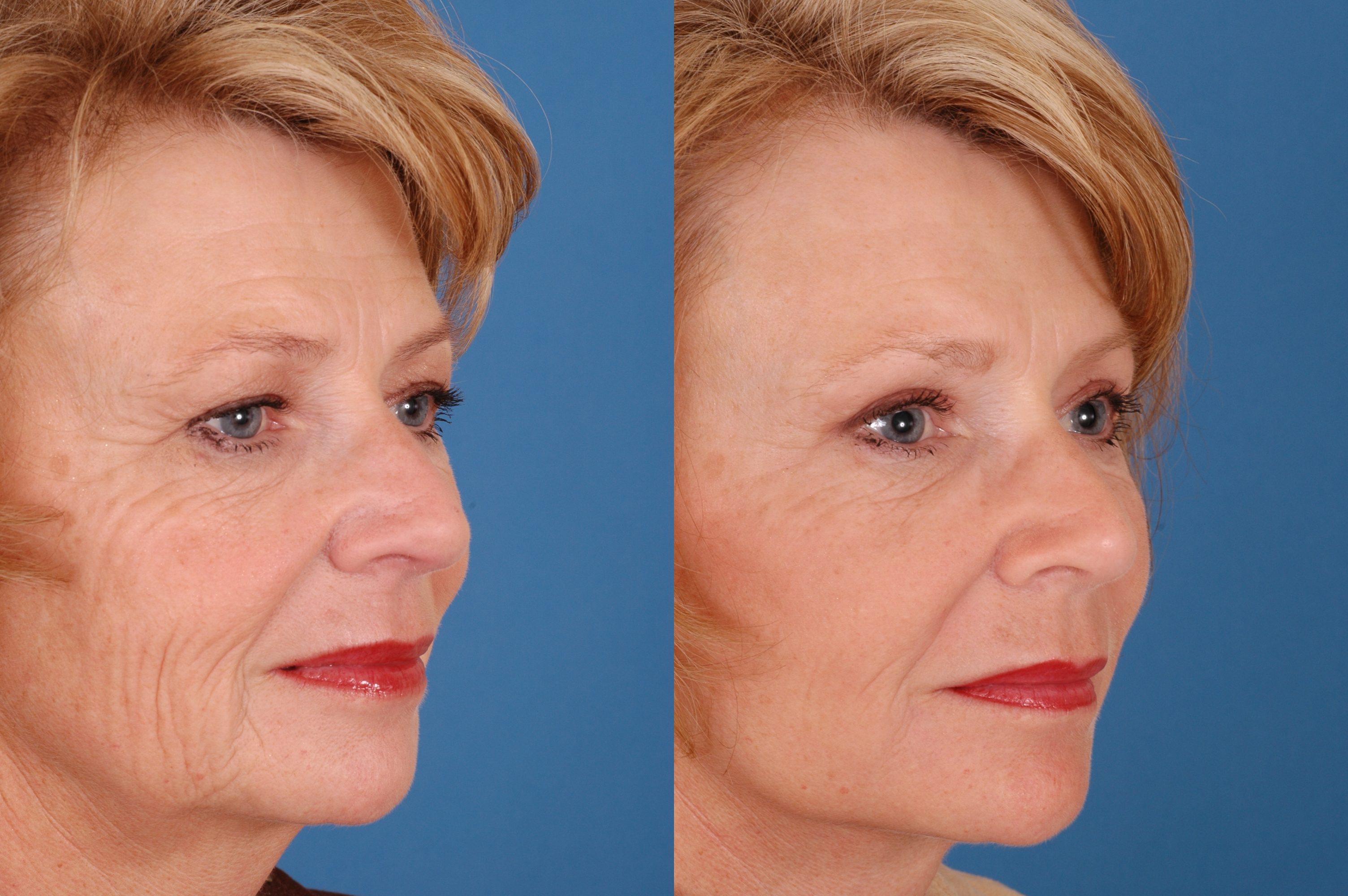 Facelift Before & After Photos Benjamin Bassichis MD, FACS