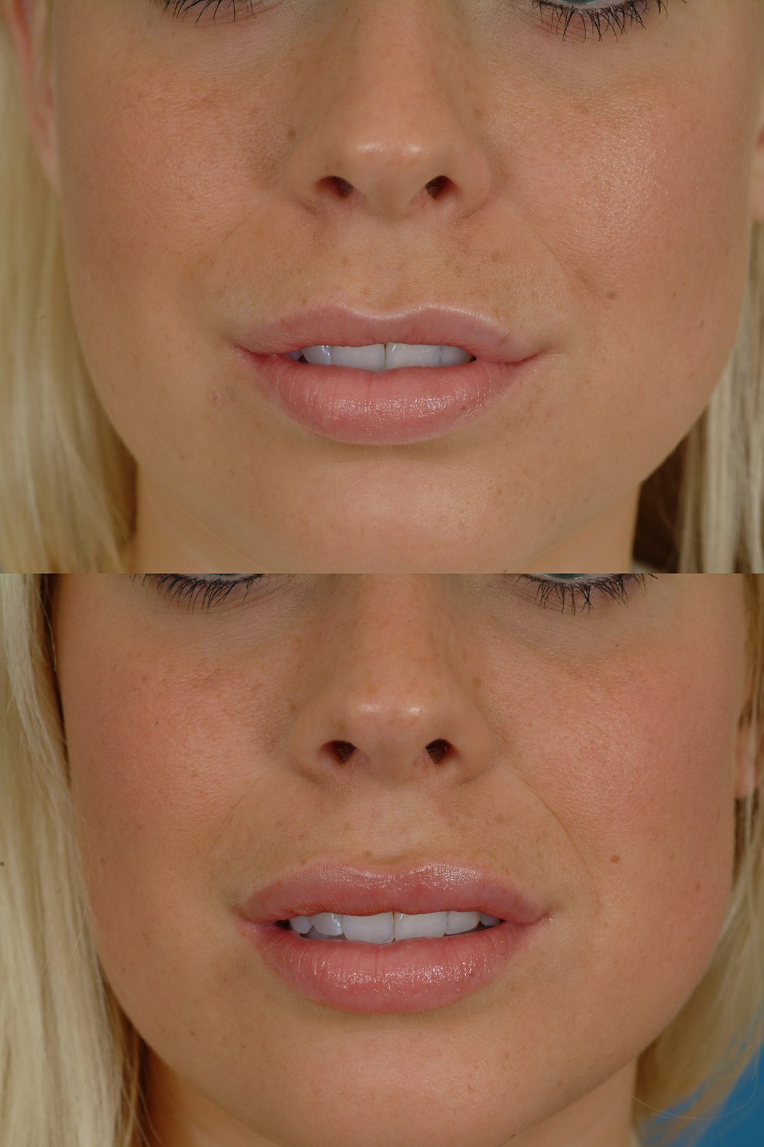 Lip Augmentation Before & After Photos Dr. Bassichis