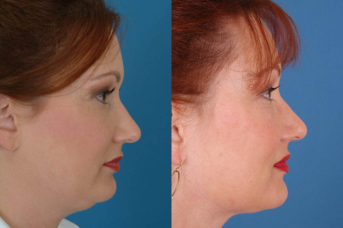 Neck Liposuction Before & After Photos Dr. Bassichis