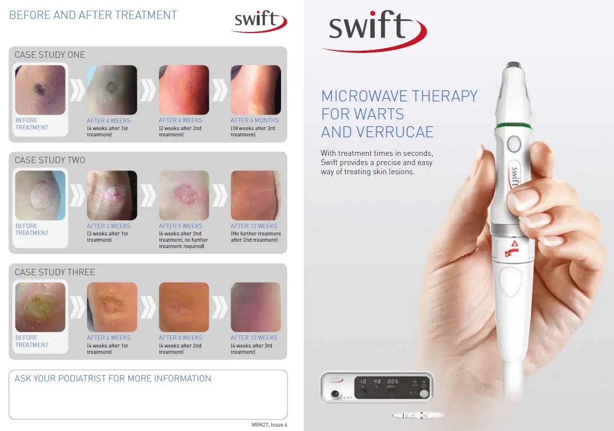 Defeat Warts With Swift A Revolutionary Microwave Treatment Advanced