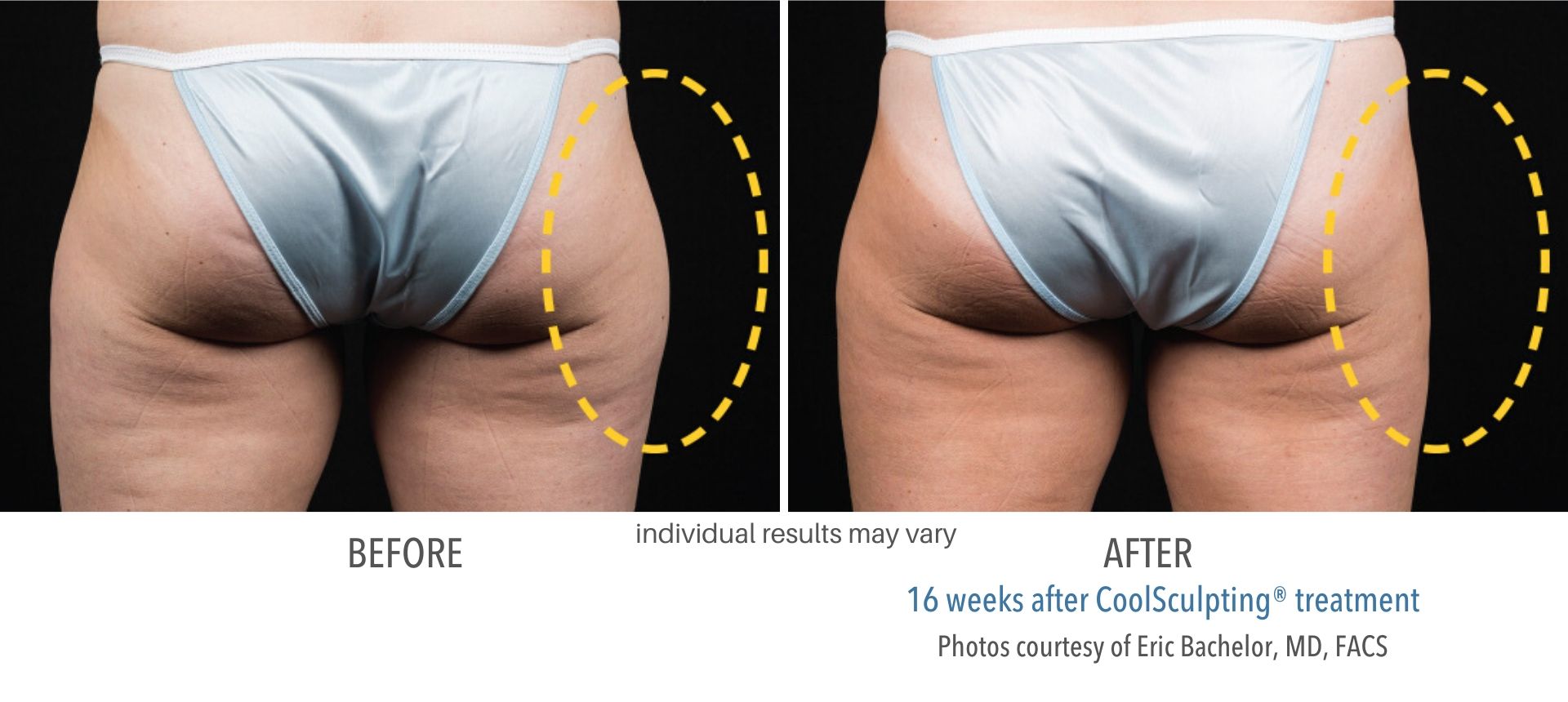 Cool Sculpting Before and After Fat Freezing Results