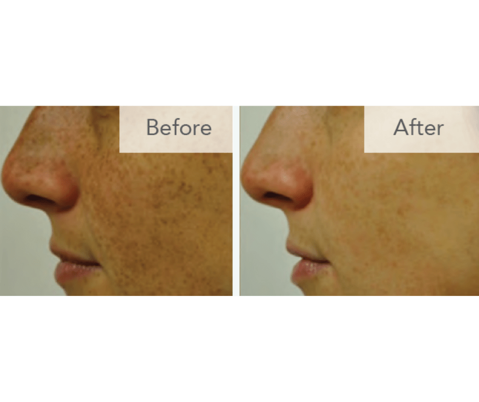 Limelight Laser Skin Treatments Revive Medical Spa, LLC