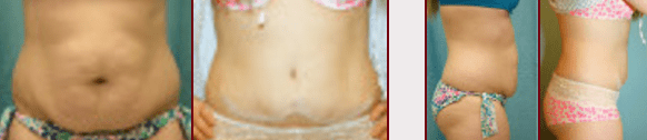 Dayton Tummy Tuck Abdominoplasty Recovery
