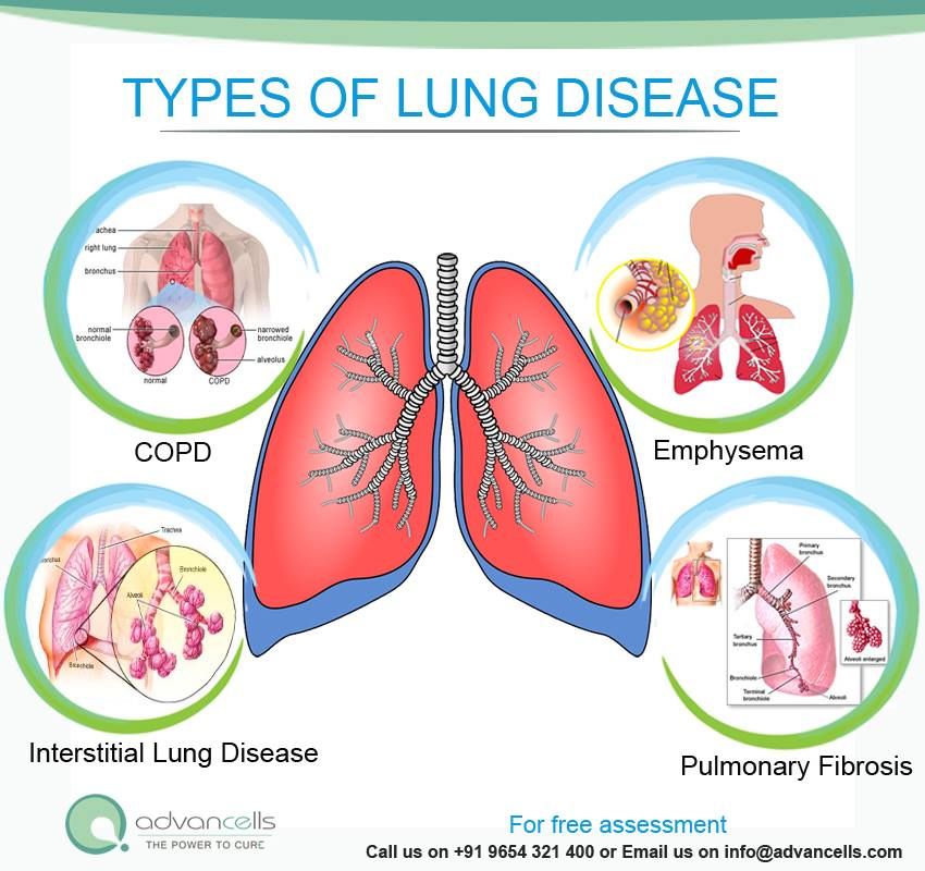 Is Chronic Lung Disease Curable With Stem Cell Therapy? Advancells