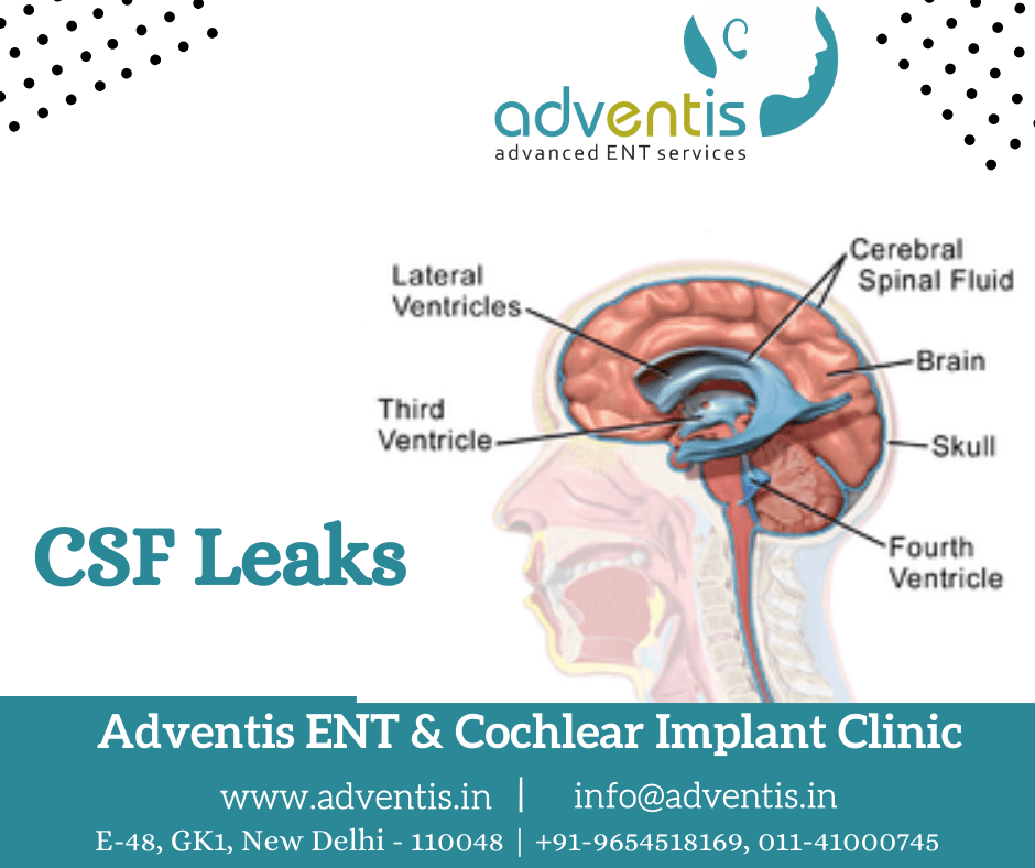 CSF Leaks - Cerebrospinal Fluid Leak Surgery & Treatment in Delhi