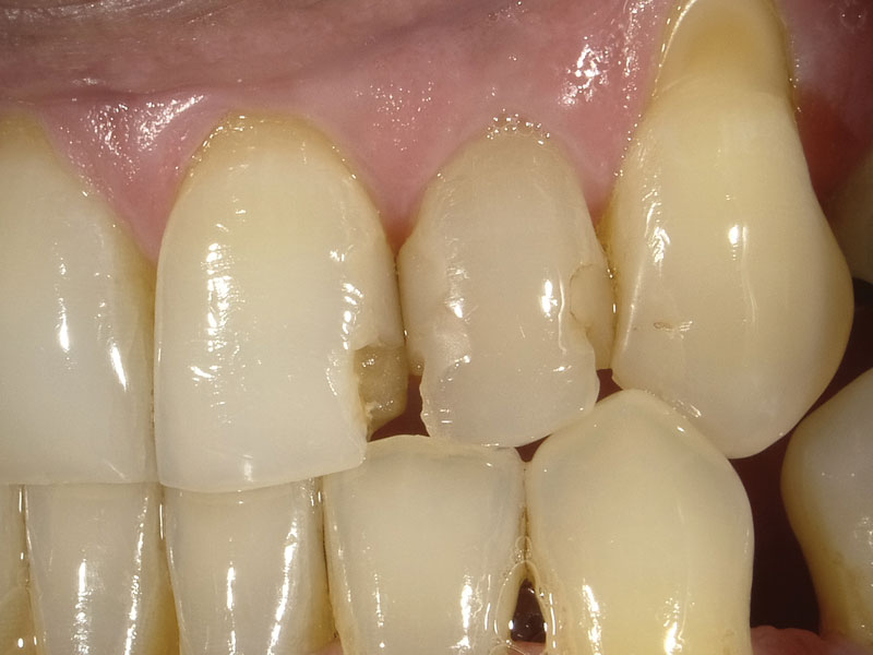 Retreating Failed Anterior Direct Composite Restorations December