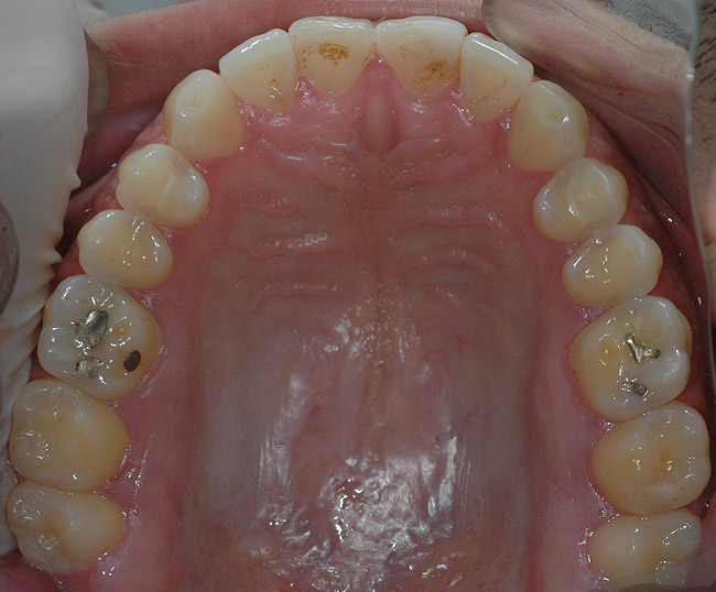 Direct Restorative Treatment of Dental Erosion Caused by