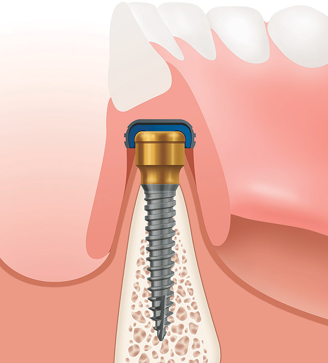 The Locator® Overdenture Implant System December 2012 Inside Dentistry