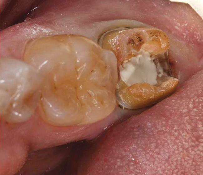 Everyday Clinical Use of TheraCal® LC December 2012 Inside Dentistry