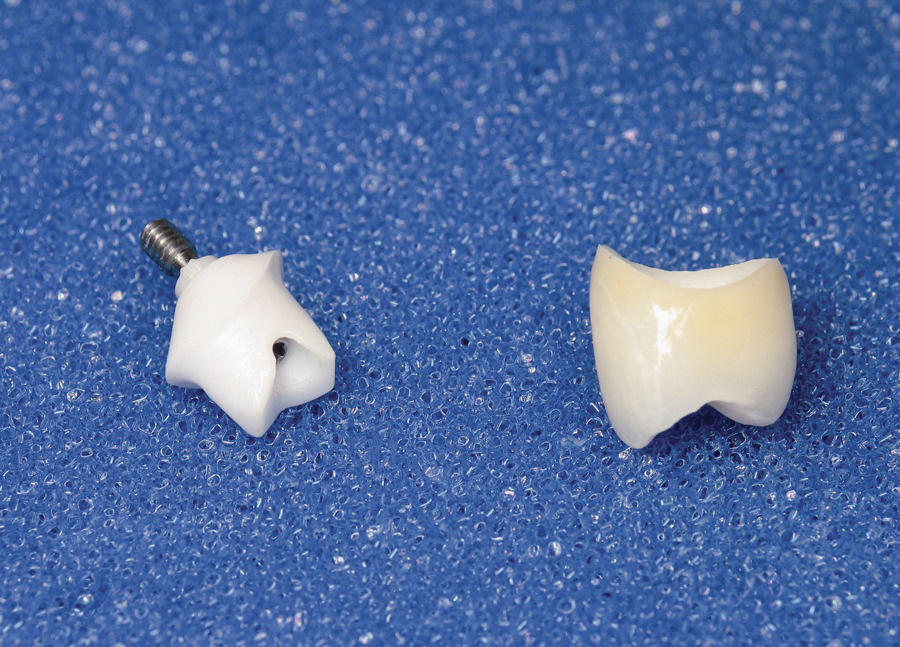 Practical Applications Improving Darkened Anterior Periimplant Tissue