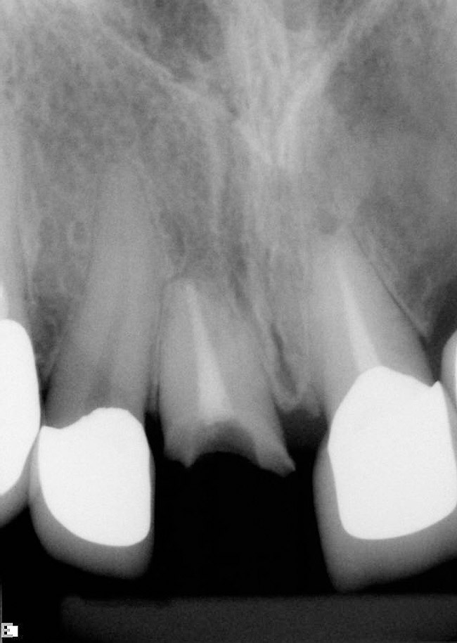 The Immediate Anterior Implant and Provisional Crown March 2009