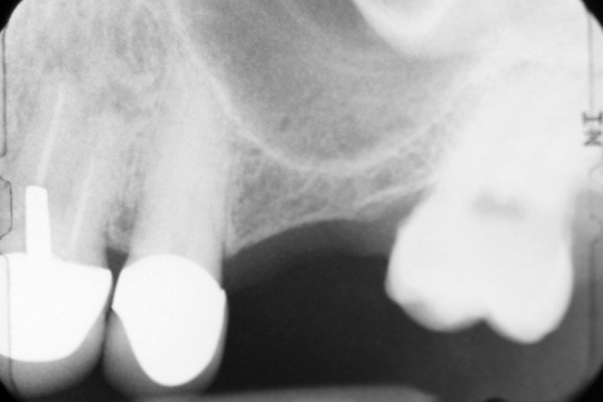 Novel Modifications to the Trephine Core/Osteotome Technique March