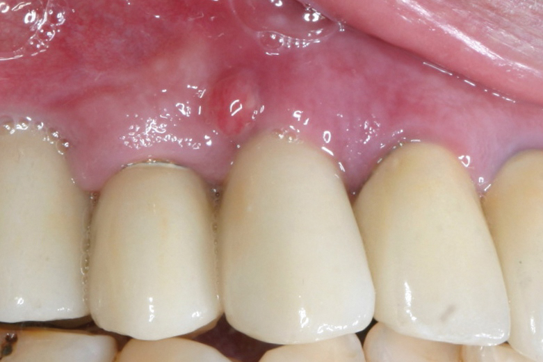 Treatment of PeriImplantitis with a Diode Laser November 2016