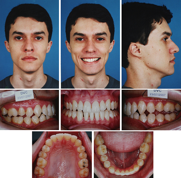 List 97+ Pictures Underbite Surgery Before And After Pictures Updated