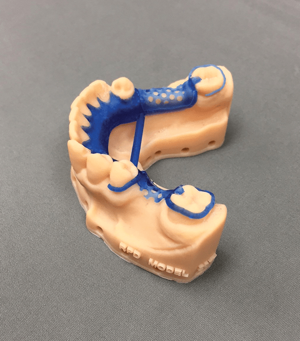 Casting Printed Removable Partial Denture Frames in Seven Steps