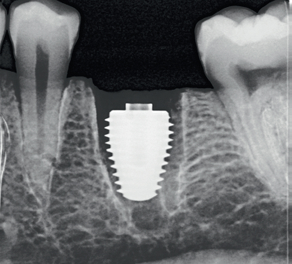 UltraWideDiameter Implants Gaining Favor for Immediate Placement in