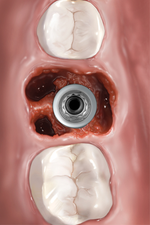 Immediate Placement of Dental Implants in Molar Extraction Sockets An