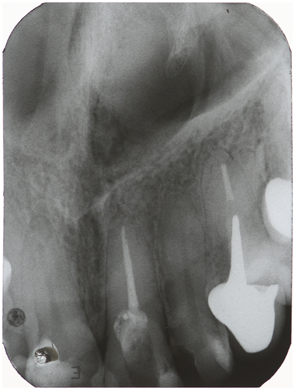 Transurgical Restoration With GlassIonomer Cement As an Option for Root Perforations Case