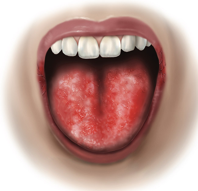 Burning Mouth Syndrome Linked to Menopause October 2011 Inside