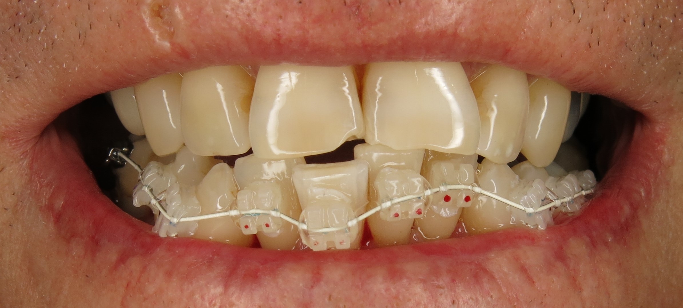 June Down to a Science CE Centering Implants With the Gingival